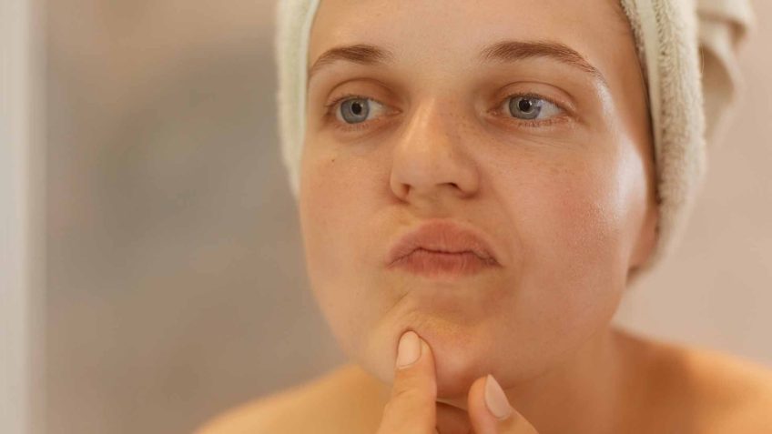The Causes of Acne in Adults