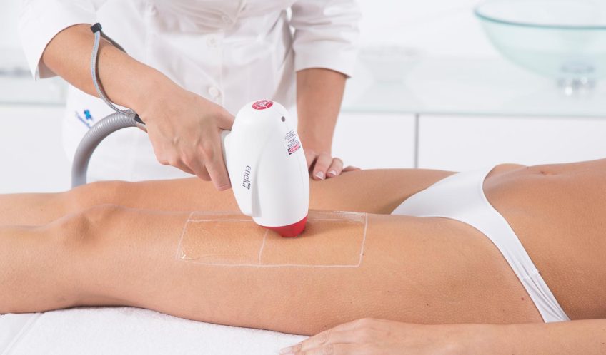 Laser Hair Removal: How it works