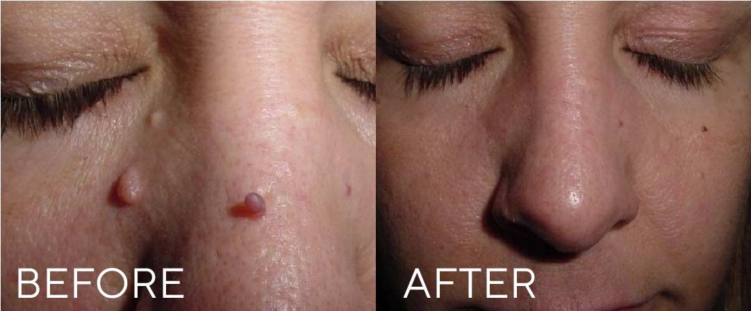 before-after-01