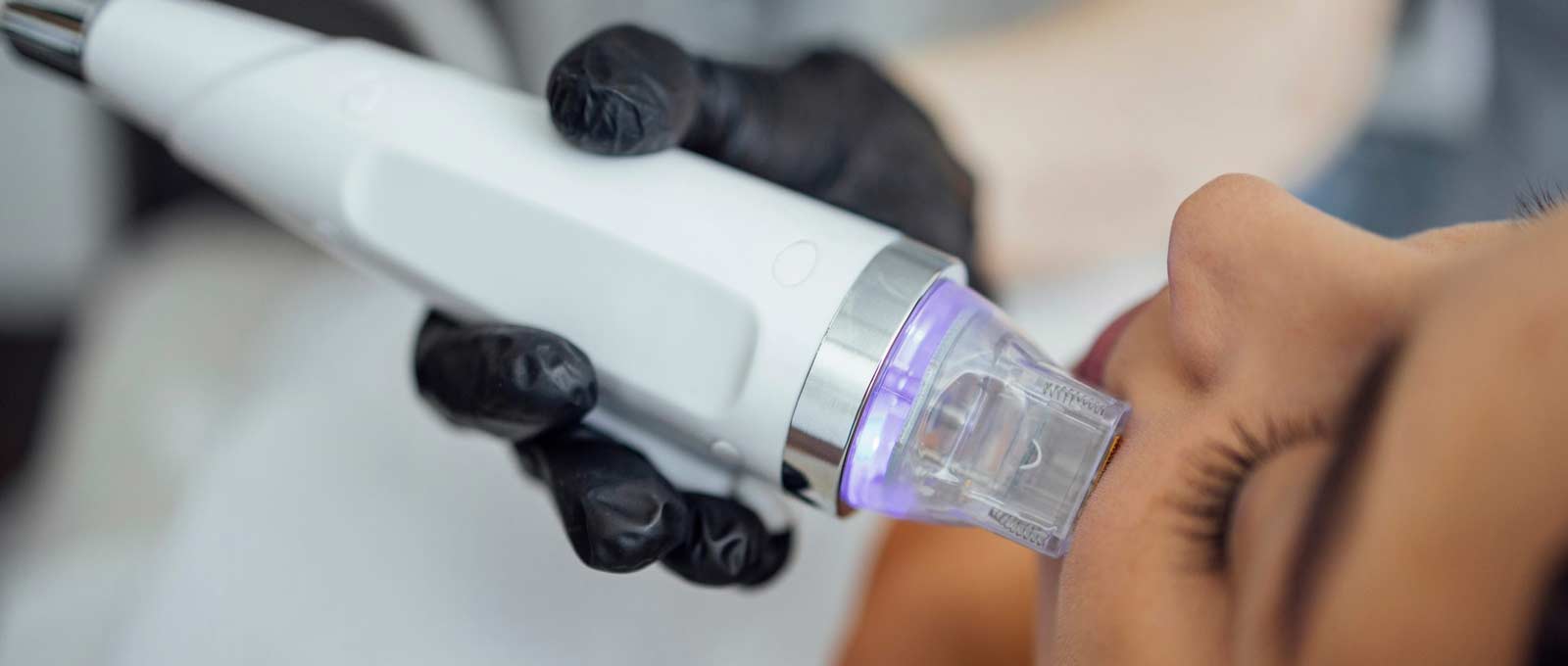 RF-3D-Microneedling
