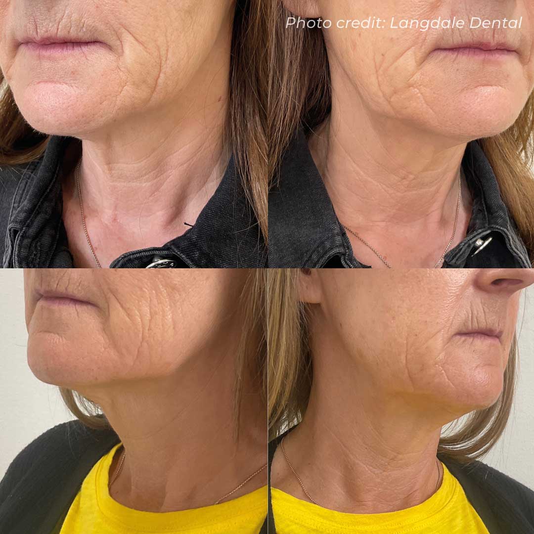 before-after-02