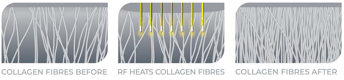 RF-Diagram